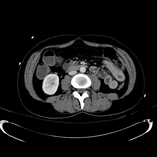 Acute myocardial infarction in CT (Radiopaedia 39947-42415 Axial C+ portal venous phase 67).jpg