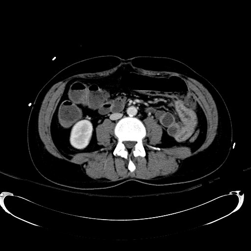 File:Acute myocardial infarction in CT (Radiopaedia 39947-42415 Axial C+ portal venous phase 70).jpg