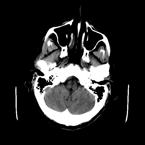 File:Acute necrotizing toxoplasma encephalitis (Radiopaedia 10683-11150 Axial non-contrast 29).jpg