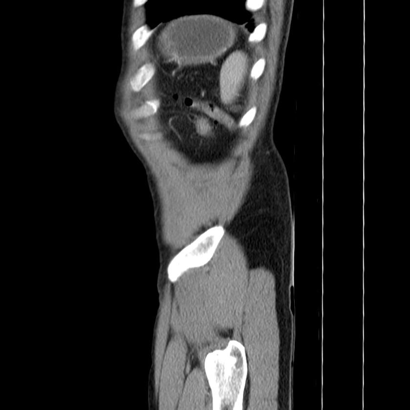 Acute pancreatitis (Radiopaedia 22572-22596 Sagittal C+ portal venous phase 50).jpg