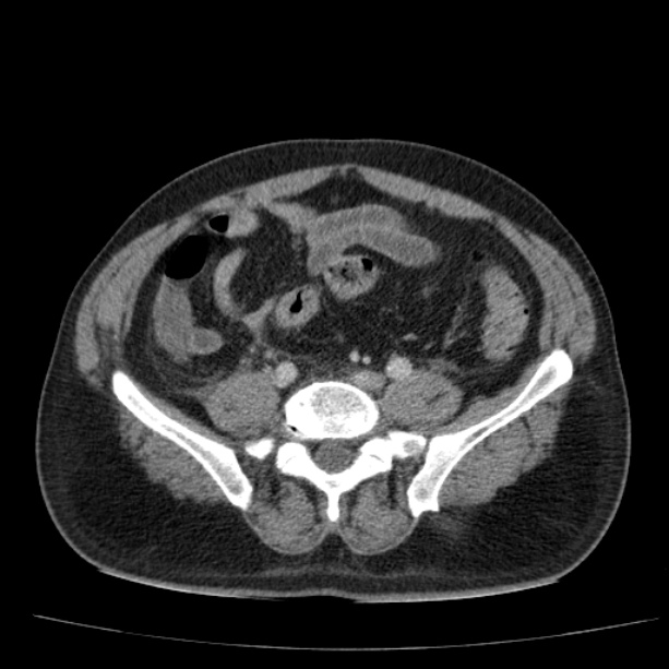Acute pancreatitis (Radiopaedia 26663-26813 Axial C+ portal venous phase 61).jpg