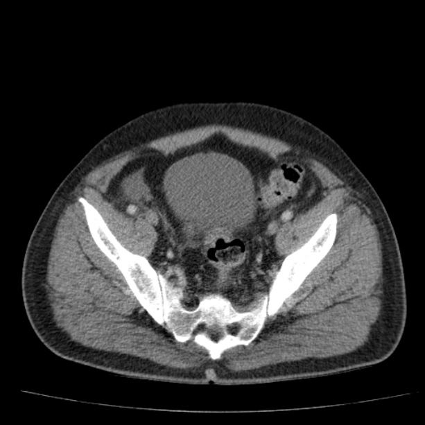 Acute pancreatitis (Radiopaedia 26663-26813 Axial C+ portal venous phase 72).jpg