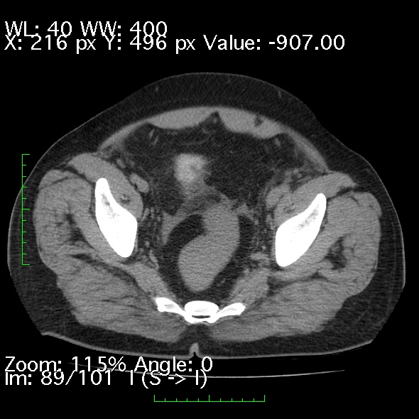 File:Acute pancreatitis (Radiopaedia 34043-35276 Axial non-contrast 89).jpg