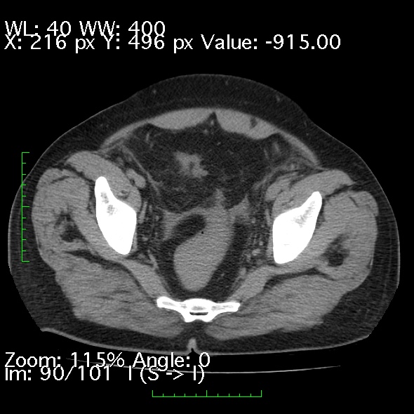 Acute pancreatitis (Radiopaedia 34043-35276 Axial non-contrast 90).jpg