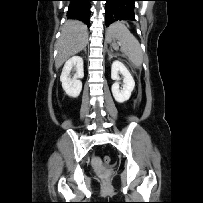 Acute pancreatitis (Radiopaedia 69236-79012 Coronal C+ portal venous phase 29).jpg