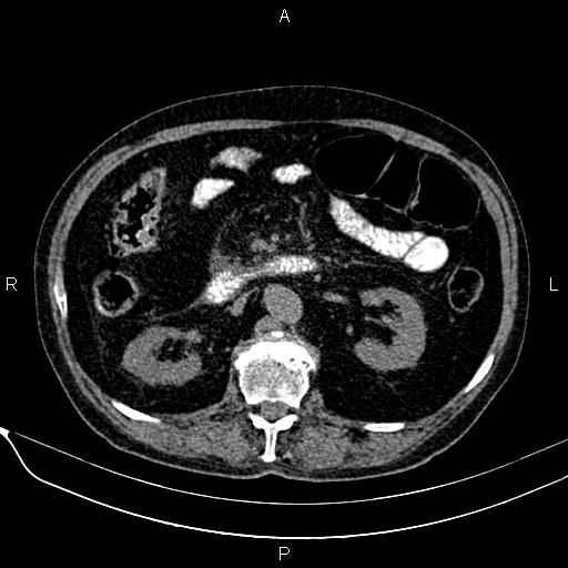 Acute pancreatitis (Radiopaedia 85146-100701 Axial non-contrast 55).jpg