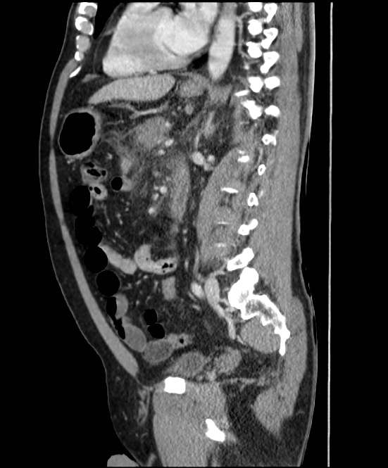 Acute pancreatitis - Balthazar E (Radiopaedia 23080-23110 Sagittal C+ portal venous phase 58).jpg