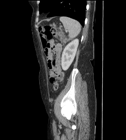 Acute pancreatitis - Balthazar E - post ERCP (Radiopaedia 27562-27772 Sagittal C+ portal venous phase 108).png