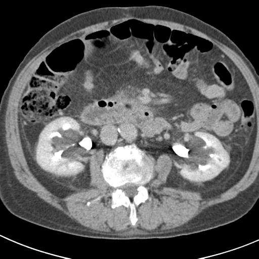 Acute pancreatitis and walled-off necrosis (Radiopaedia 29888-30403 Axial C+ delayed 41).jpg