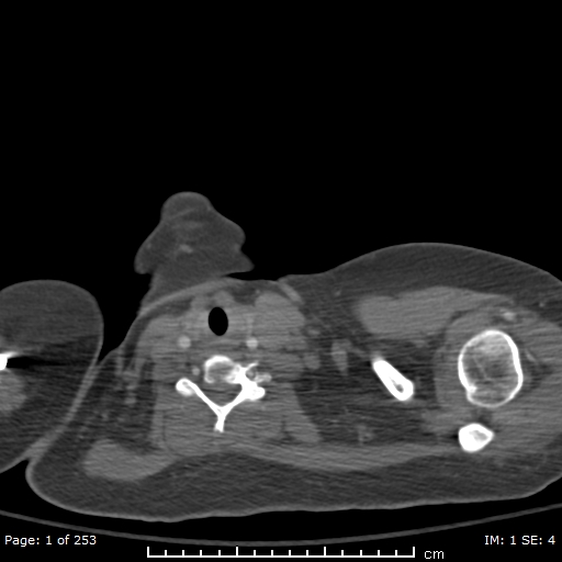 File:Acute pulmonary embolism (Radiopaedia 69902).jpg