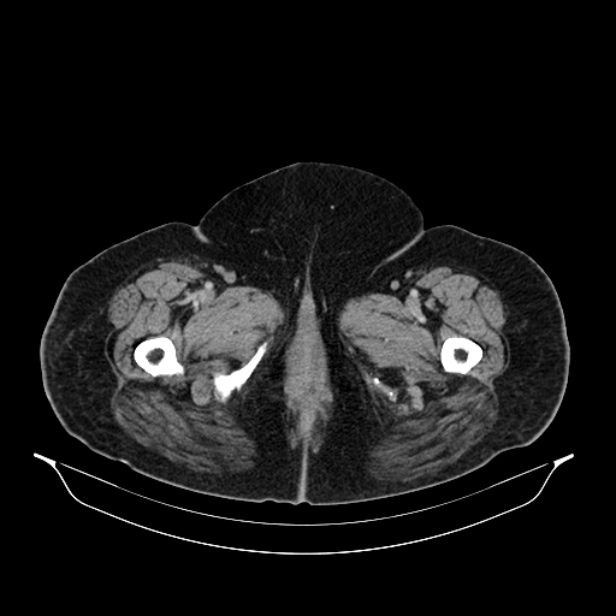Acute pyelonephritis (Radiopaedia 25657-25837 Axial renal parenchymal phase 88).jpg