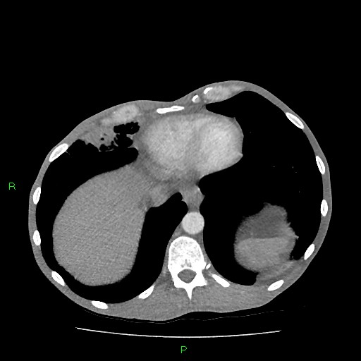 File:Acute right lung abscess (Radiopaedia 34806-36258 Axial C+ arterial phase 153).jpg