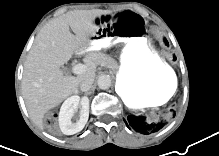 Acute small bowel (ileal) volvulus (Radiopaedia 71740-82139 Axial C+ portal venous phase 64).jpg