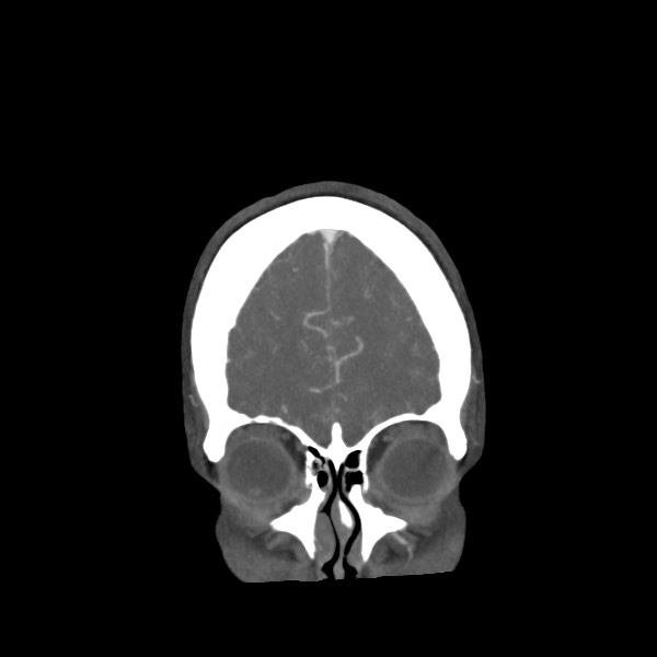 Acute subarachnoid hemorrhage and accessory anterior cerebral artery (Radiopaedia 69231-79009 Coronal C+ arterial phase 15).jpg