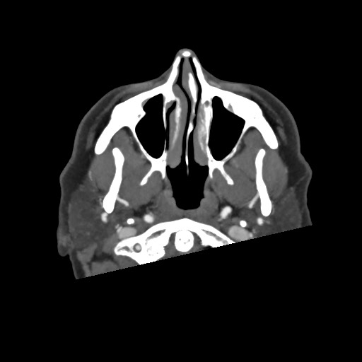 Acute subarachnoid hemorrhage and accessory anterior cerebral artery (Radiopaedia 69231-79009 D 2).jpg