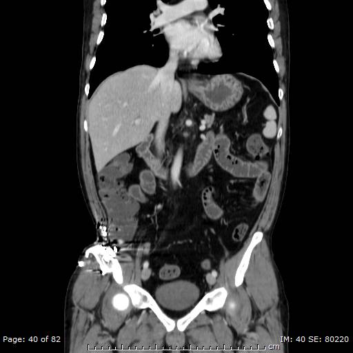 Acute superior mesenteric artery occlusion (Radiopaedia 43636-47060 Coronal C+ portal venous phase 25).jpg