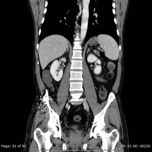 Acute superior mesenteric artery occlusion (Radiopaedia 43636-47060 Coronal C+ portal venous phase 37).jpg