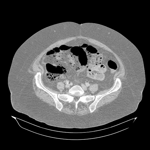 Acute superior mesenteric artery occlusion (Radiopaedia 51288-56960 Axial lung window 51).jpg