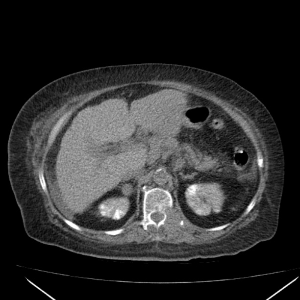 Acute tubular necrosis (Radiopaedia 28077-28334 Axial non-contrast 24).jpg