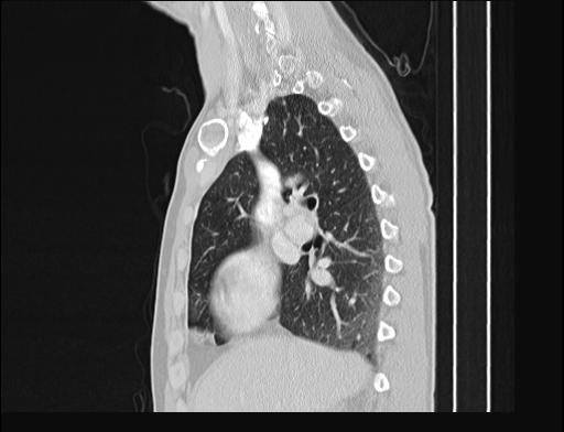 Addison disease (Radiopaedia 49318-54412 Sagittal lung window 40).jpg