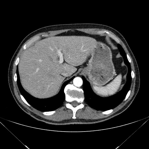 File:Adenocarcinoma of the lung (Radiopaedia 59871-67325 Axial C+ arterial phase 85).jpg