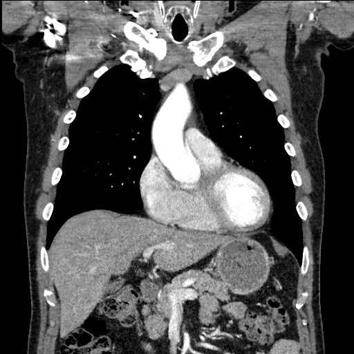 Adenocarcinoma of the lung (Radiopaedia 59871-67325 Coronal C+ arterial phase 22).jpg