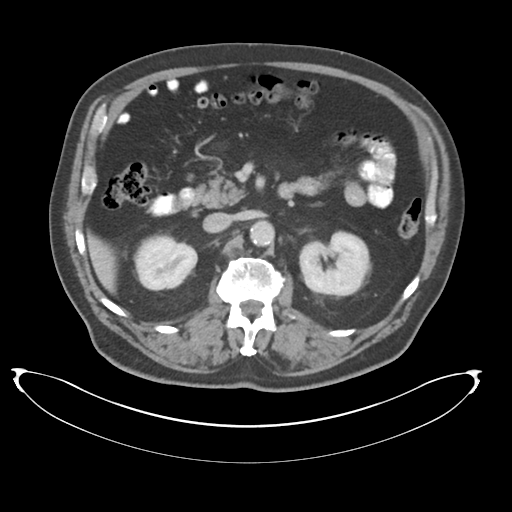 Adenocarcioma of rectum- T1 lesion (Radiopaedia 36921-38547 Axial C+ portal venous phase 33).png