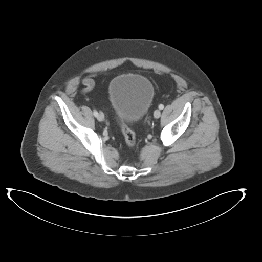 Adenocarcioma of rectum- T1 lesion (Radiopaedia 36921-38547 Axial C+ portal venous phase 74).png