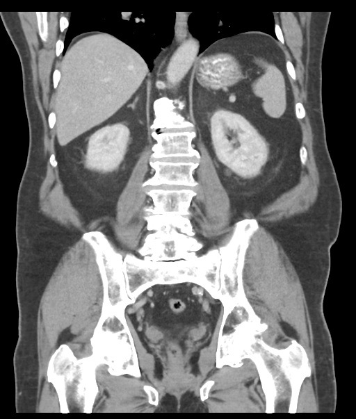 Adenocarcioma of rectum- T1 lesion (Radiopaedia 36921-38547 Coronal C+ portal venous phase 42).png