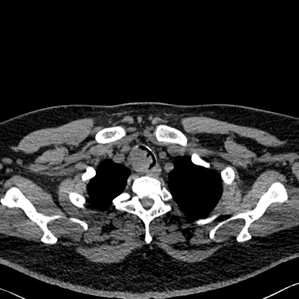Adenoid cystic carcinoma of the trachea (Radiopaedia 49042-54137 Axial non-contrast 34).jpg