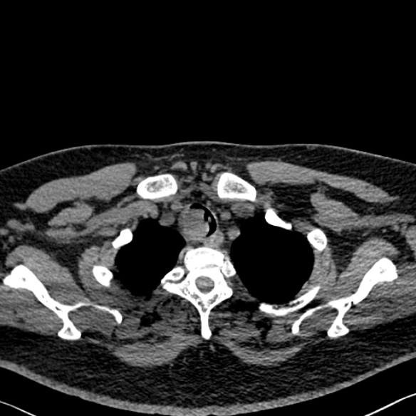 Adenoid cystic carcinoma of the trachea (Radiopaedia 49042-54137 Axial non-contrast 37).jpg
