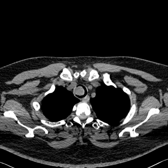 Adenoid cystic carcinoma of the trachea (Radiopaedia 49042-54137 Axial non-contrast 47).jpg