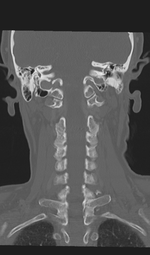 Adenoid cystic tumor of palate (Radiopaedia 46980-51518 Coronal bone window 44).png