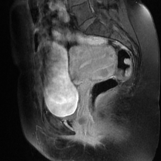 File:Adenoma malignum of cervix (Radiopaedia 66441-75705 Sagittal T1 C+ fat sat 9).jpg