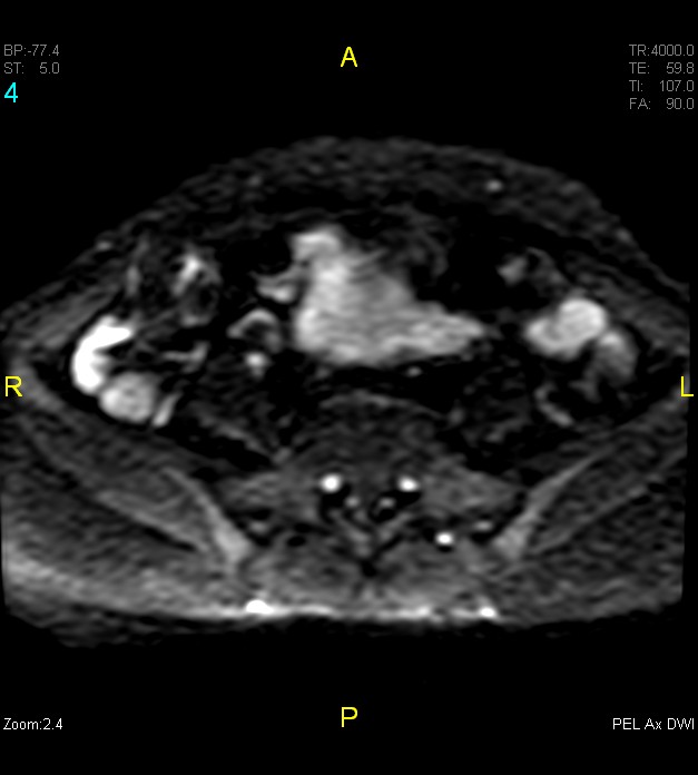 Adenomyosis (Radiopaedia 43504-46889 Axial DWI 4).jpg