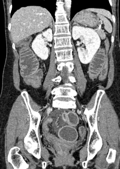 Adhesional small bowel obstruction (Radiopaedia 48397-53305 Coronal C+ portal venous phase 227).jpg