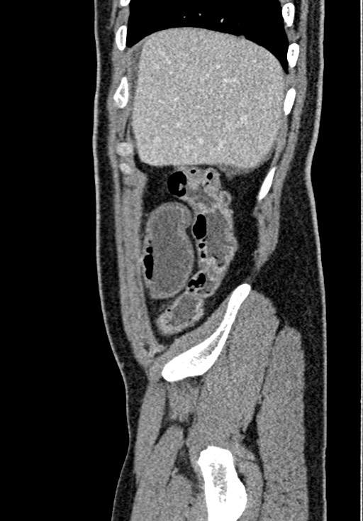 Adhesional small bowel obstruction (Radiopaedia 58900-66131 Sagittal C+ portal venous phase 40).jpg