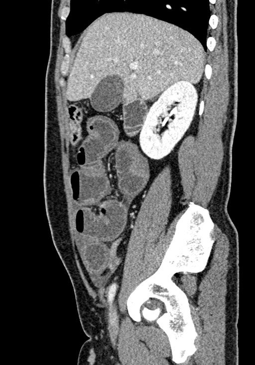 Adhesional small bowel obstruction (Radiopaedia 58900-66131 Sagittal C+ portal venous phase 76).jpg