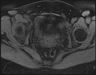 File:Adnexal multilocular cyst (O-RADS US 3. O-RADS MRI 3) (Radiopaedia 87426-103754 Axial 190).jpeg