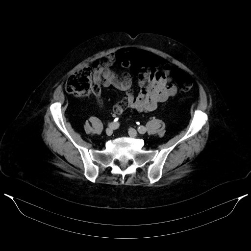 Adrenal cortical carcinoma (Radiopaedia 64017-72769 Axial C+ delayed 56).jpg