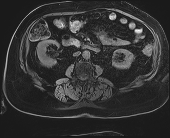 Adrenal cortical carcinoma (Radiopaedia 64017-72770 Axial T1 C+ fat sat 32).jpg