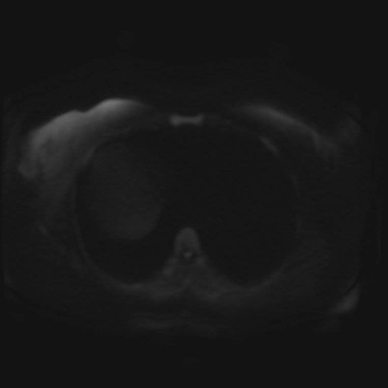 Adrenal cortical carcinoma (Radiopaedia 70906-81116 Axial DWI 30).jpg