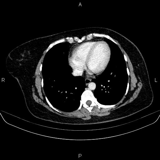 Adrenal cortical carcinoma (Radiopaedia 84882-100379 Axial C+ portal venous phase 3).jpg