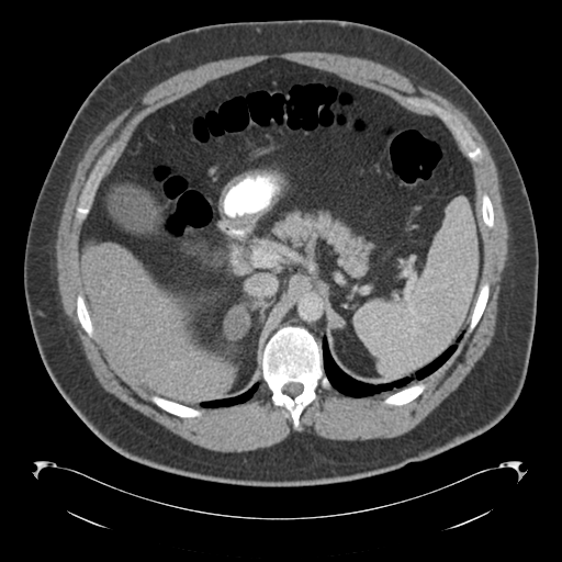 File:Adrenal cyst (Radiopaedia 45625-49776 Axial C+ portal venous phase 29).png
