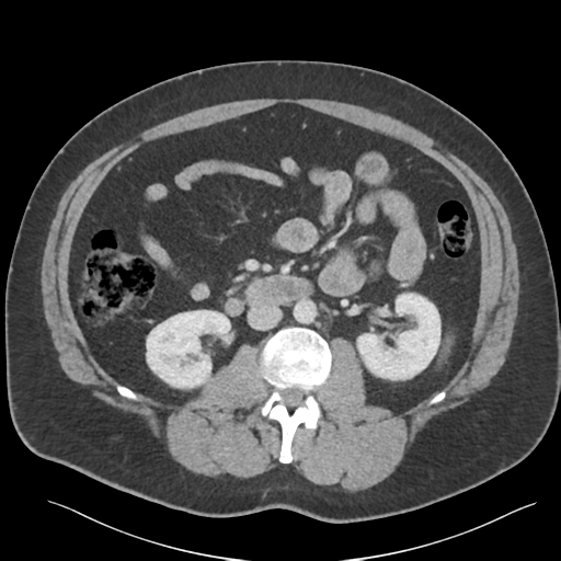 File:Adrenal cyst (Radiopaedia 45625-49777 Axial C+ portal venous phase 49).png