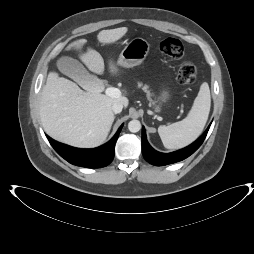 File:Adrenal cyst (Radiopaedia 45625-49778 AXIAL THICK 60 sec 12).png