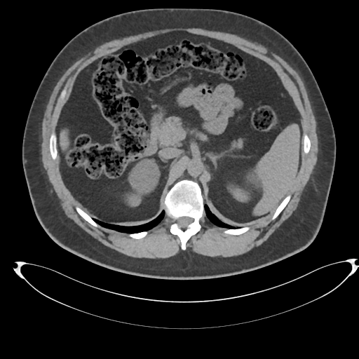 Adrenal cyst (Radiopaedia 45625-49778 Axial non-contrast 36).png