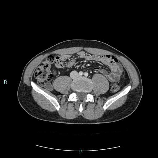 Adrenal cystic lymphangioma (Radiopaedia 83161-97534 Axial C+ portal venous phase 61).jpg