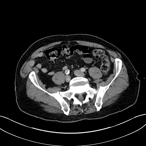 Adrenal lymphoma (Radiopaedia 73730-84529 Axial C+ portal venous phase 89).jpg