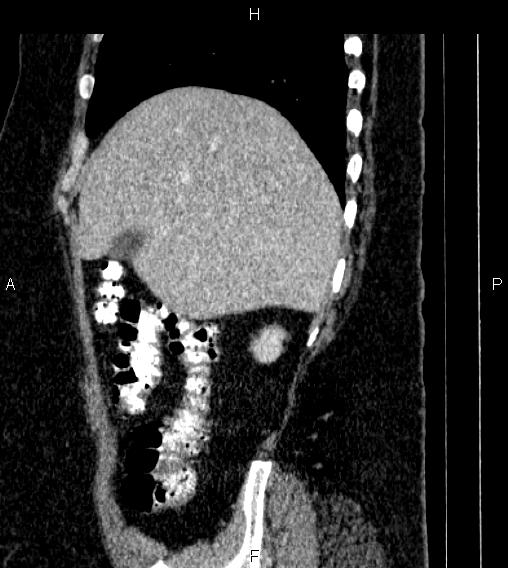 Adrenal myelolipoma (Radiopaedia 84319-99617 Sagittal renal cortical phase 18).jpg